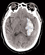 Image of intracranial hemorrhage