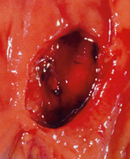 Image of gastrointestinal bleed