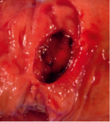 Gastrointestinal bleeding case Gastrointestinal bleeding case