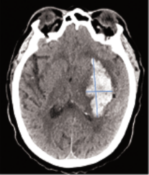 Hemorrhage case Hemorrhage case