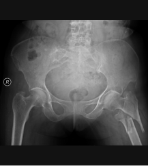 Orthopedic fracture case Orthopedic fracture case